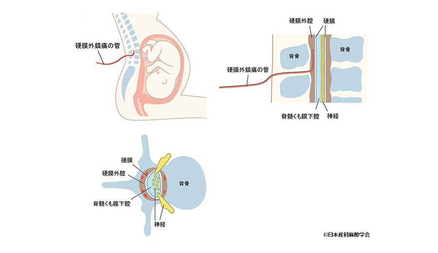 ・硬膜外麻酔の方法