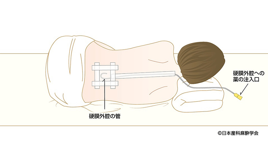 ・硬膜外麻酔の方法